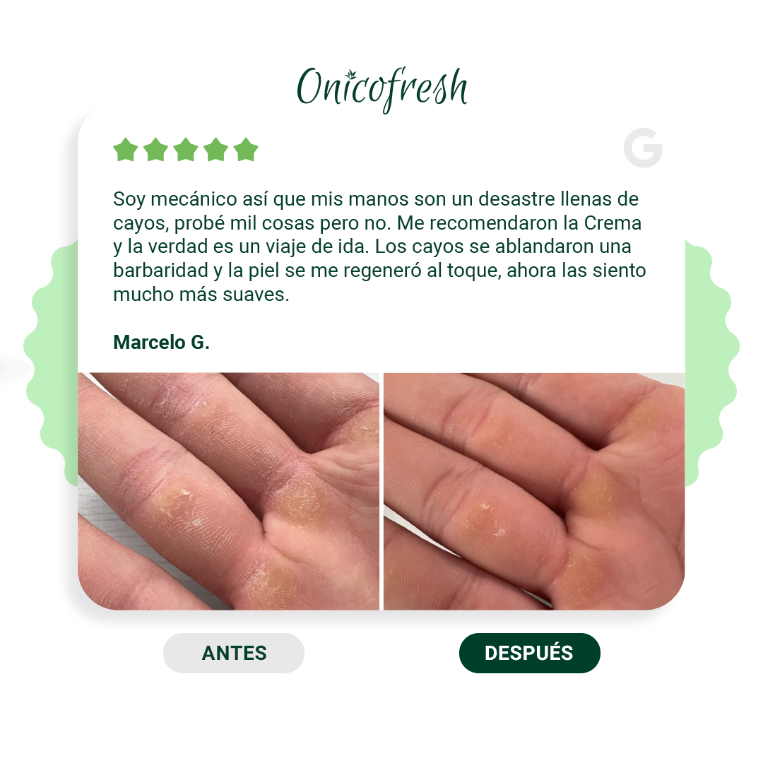 Kit Antihongos Manos, pies, cuerpo y zonas sensibles: 2 Cremas 75 ml c/u