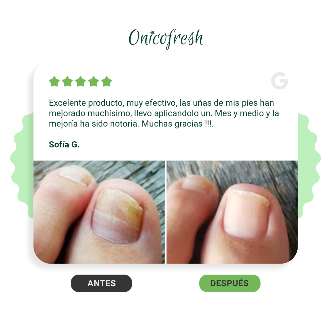 Onicofresh® KIT para Uñas, Manos y Pies: 2 Fitospray + 1 Crema 75 ml c/u
